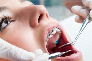 Material de ortodoncista